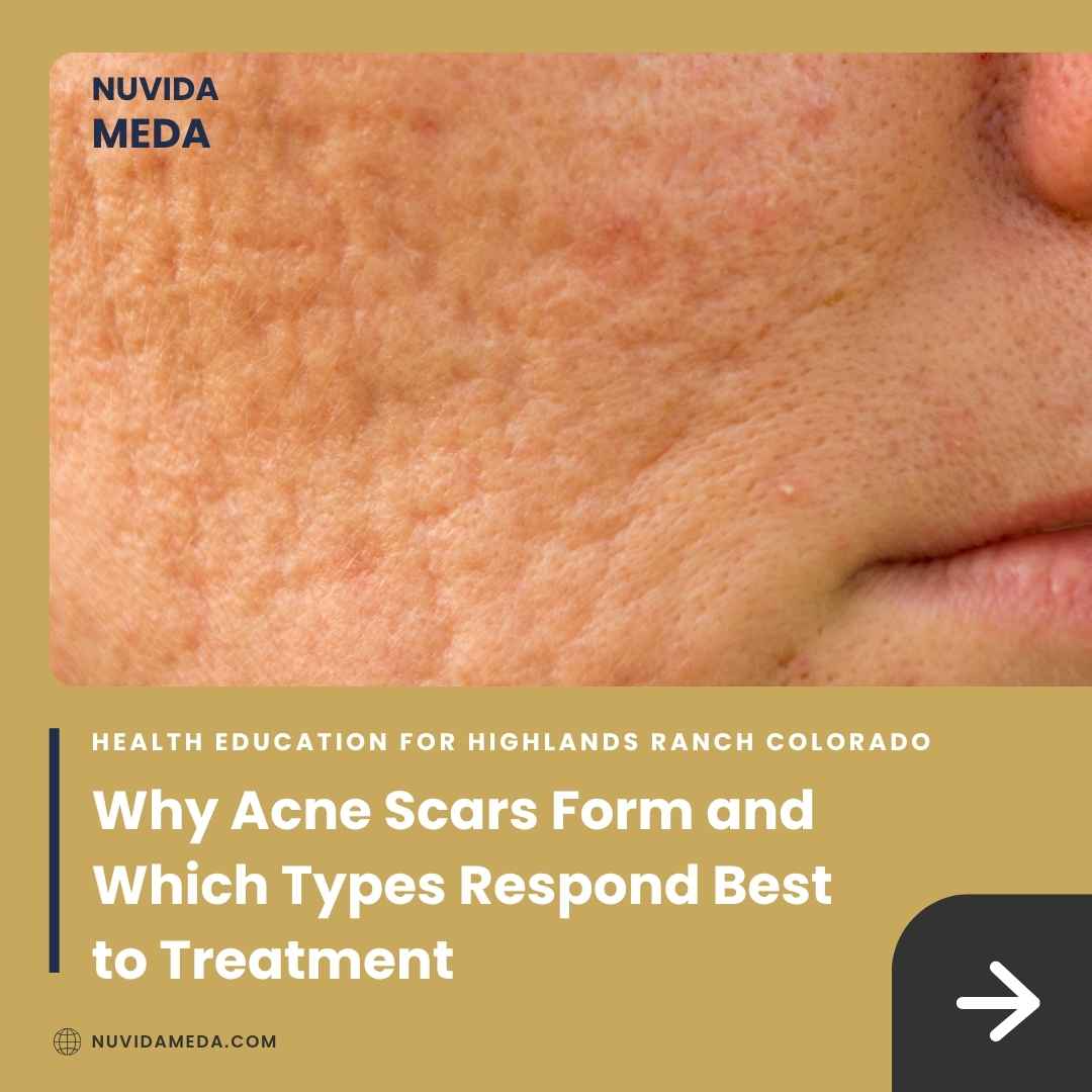 Why Acne Scars Form and Which Types Respond Best to Treatment